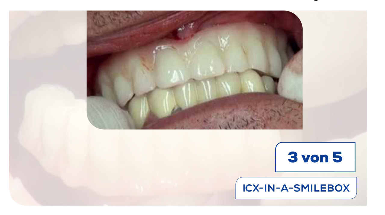 Sofortprovisorium mit dem ICX-IN-A-SMILEBOX-System